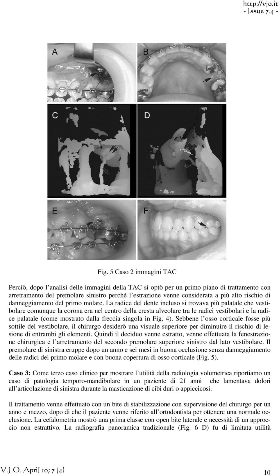 La radice del dente incluso si trovava più palatale che vestibolare comunque la corona era nel centro della cresta alveolare tra le radici vestibolari e la radice palatale (come mostrato dalla