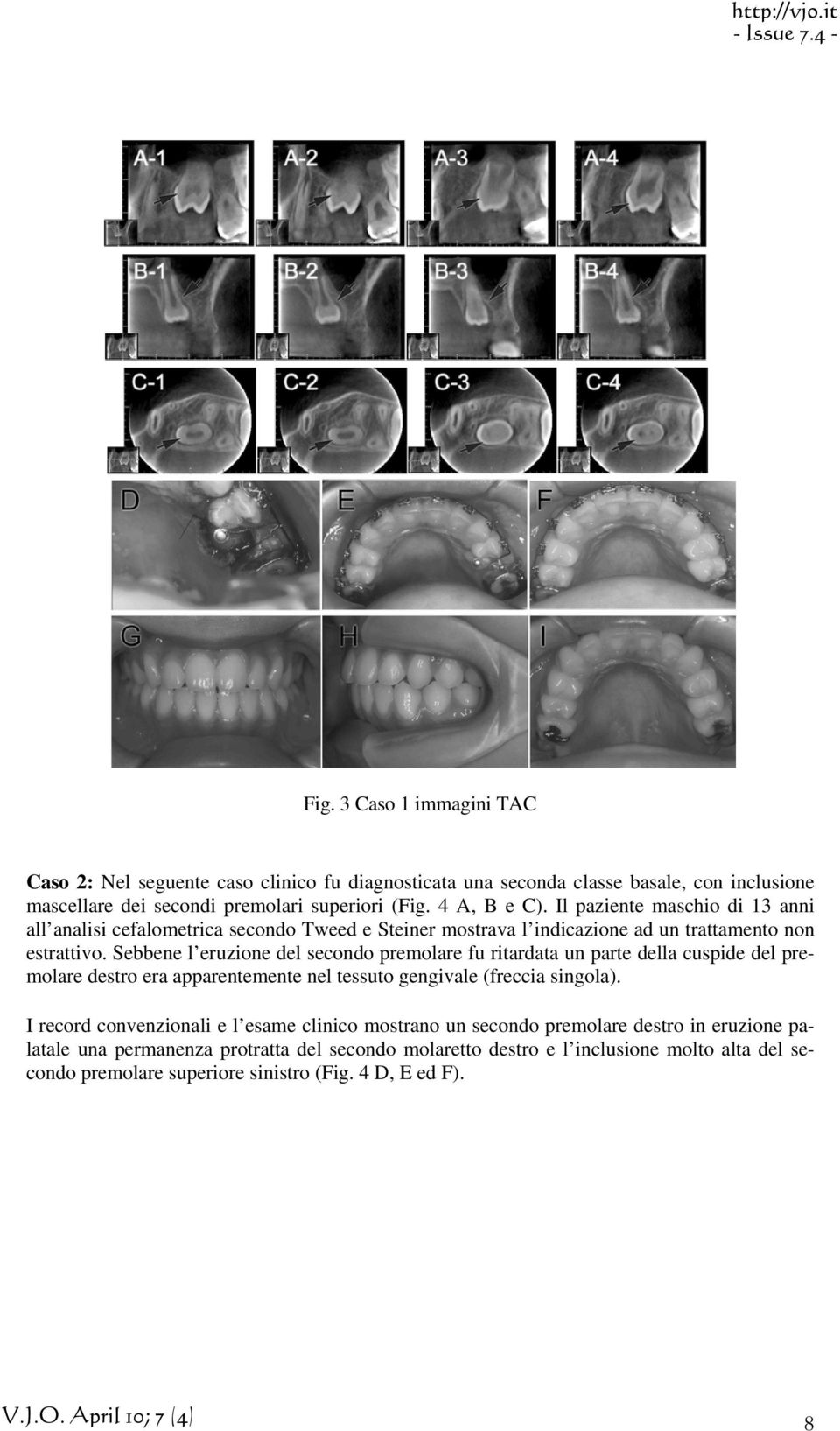 Sebbene l eruzione del secondo premolare fu ritardata un parte della cuspide del premolare destro era apparentemente nel tessuto gengivale (freccia singola).