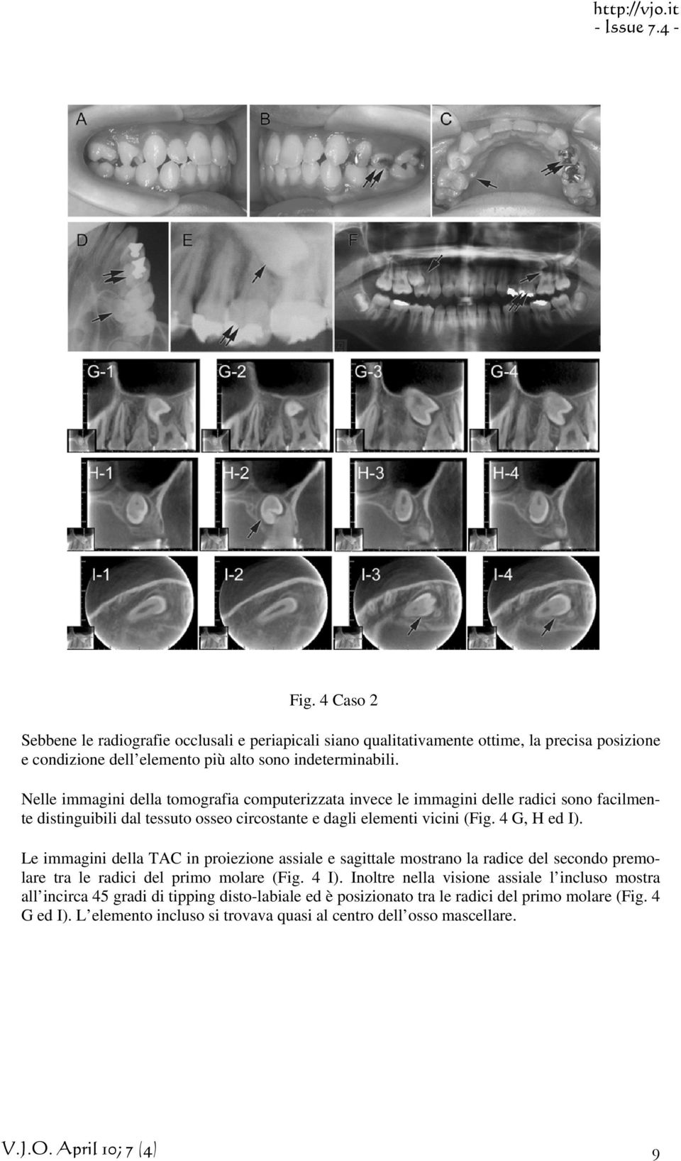 4 G, H ed I). Le immagini della TAC in proiezione assiale e sagittale mostrano la radice del secondo premolare tra le radici del primo molare (Fig. 4 I).