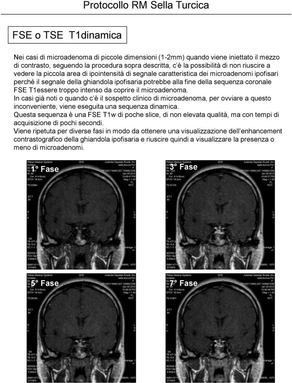 intenso da coprire il microadenoma. In casi già noti o quando c è il sospetto clinico di microadenoma, per ovviare a questo inconveniente, viene eseguita una sequenza dinamica.