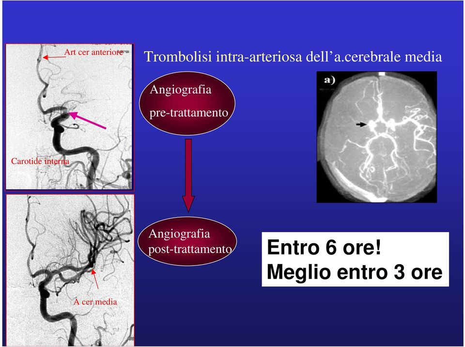cerebrale media Angiografia pre-trattamento