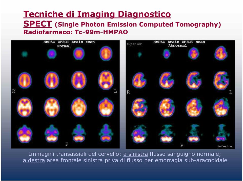 transassiali del cervello: a sinistra flusso sanguigno normale;