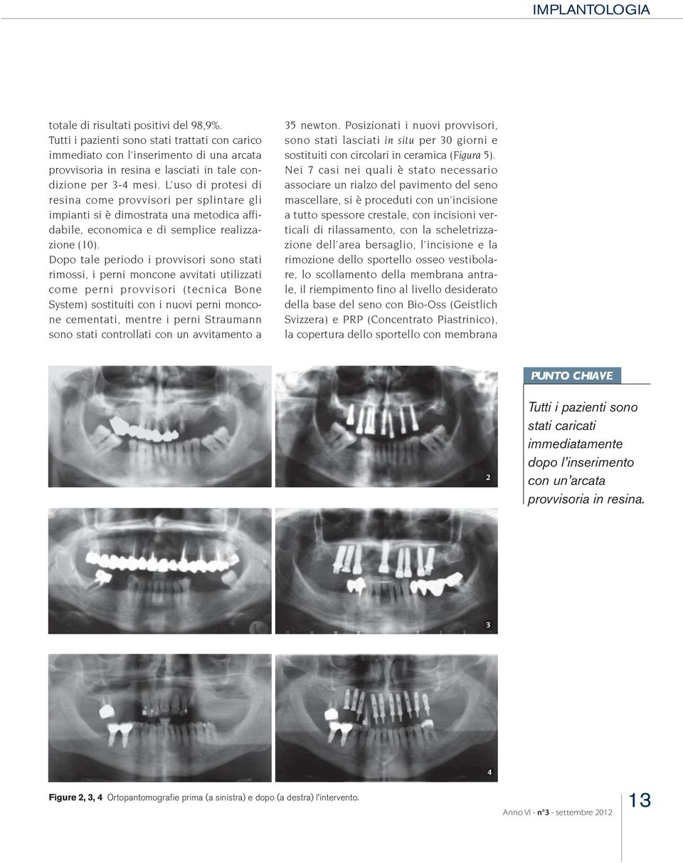 Dopo tale periodo i provvisori sono stati rimossi, i perni moncone avvitati utilizzati come perni provvisori (tecnica Bone System) sostituiti con i nuovi perni moncone cementati, mentre i perni