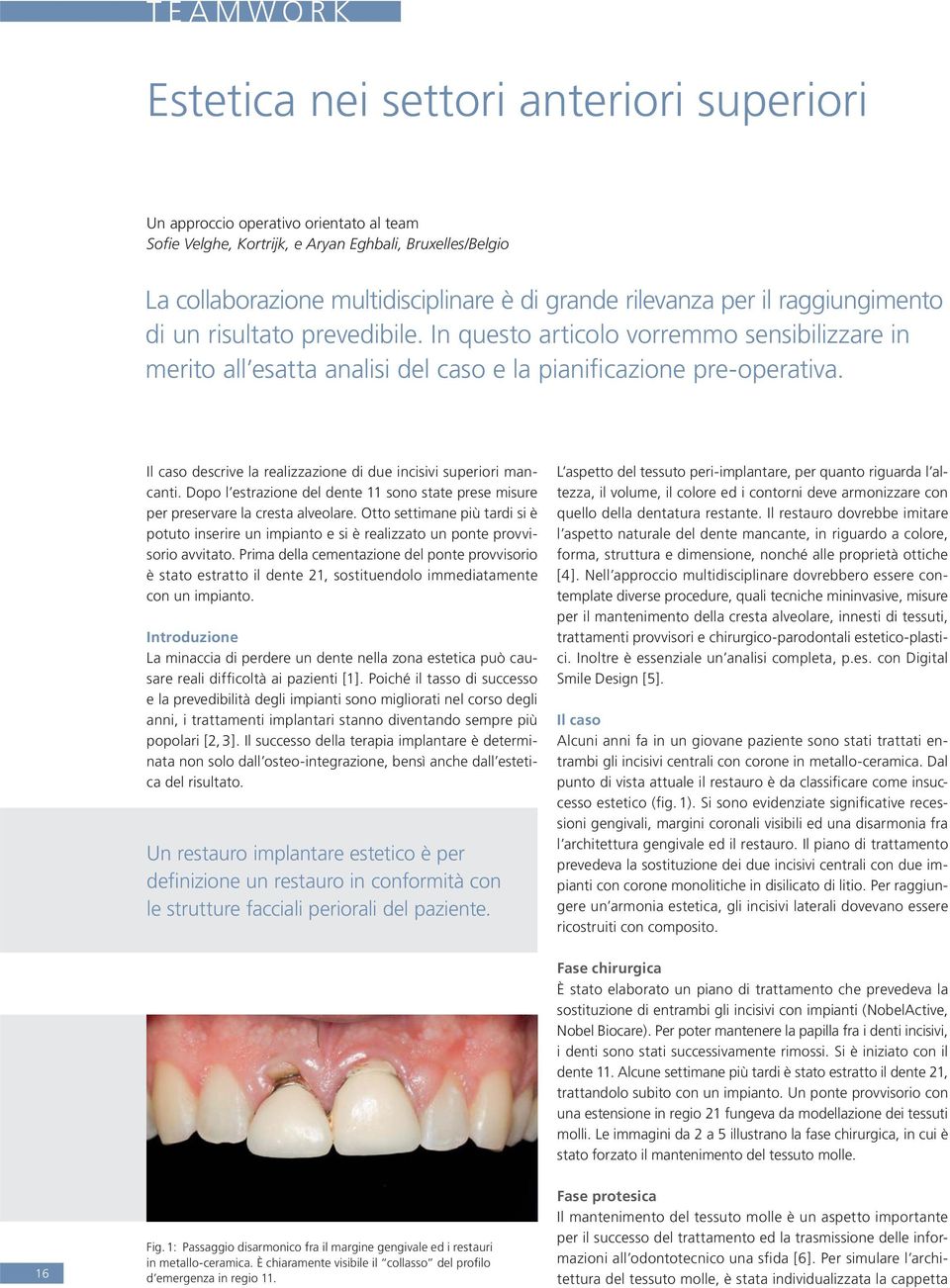 Il caso descrive la realizzazione di due incisivi superiori mancanti. Dopo l estrazione del dente 11 sono state prese misure per preservare la cresta alveolare.