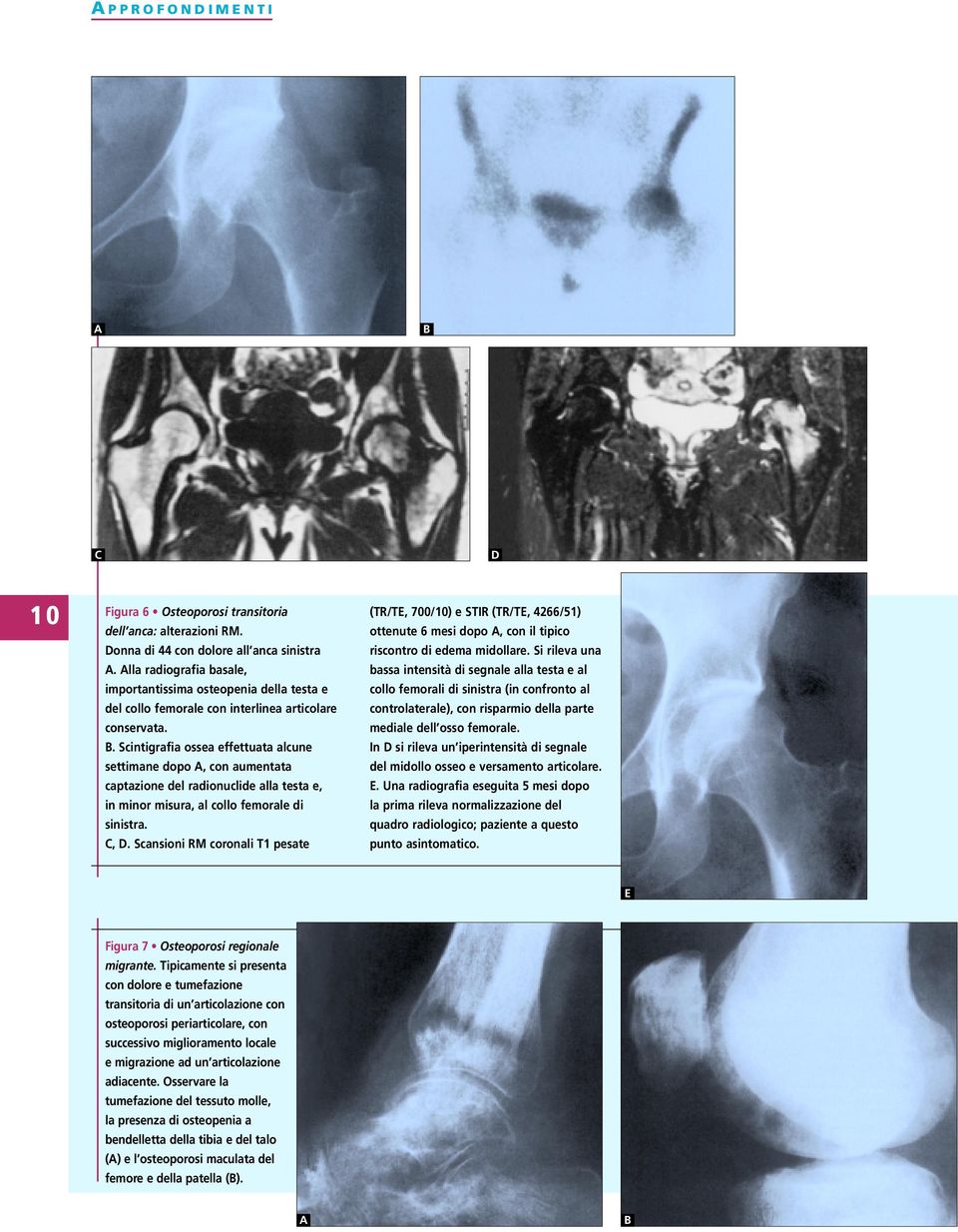 . Scintigrafia ossea effettuata alcune settimane dopo, con aumentata captazione del radionuclide alla testa e, in minor misura, al collo femorale di sinistra.,. Scansioni RM coronali T1 pesate (TR/TE, 700/10) e STIR (TR/TE, 4266/51) ottenute 6 mesi dopo, con il tipico riscontro di edema midollare.