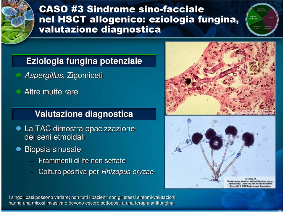 Altre muffe rare Valutazione diagnostica La TAC dimostra opacizzazione dei seni