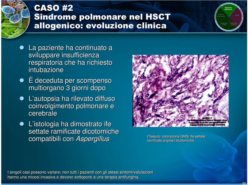 coinvolgimento polmonare e cerebrale L istologia ha dimostrato ife settate ramificate dicotomiche compatibili con Aspergillus