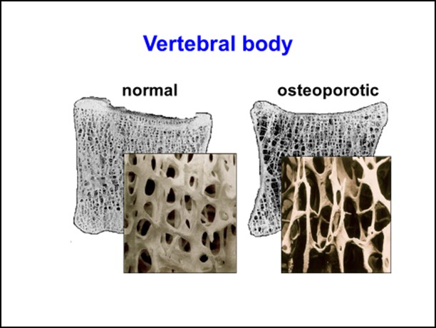 Quali pazienti con ipercalciuria sono a rischio diosteoporosi?