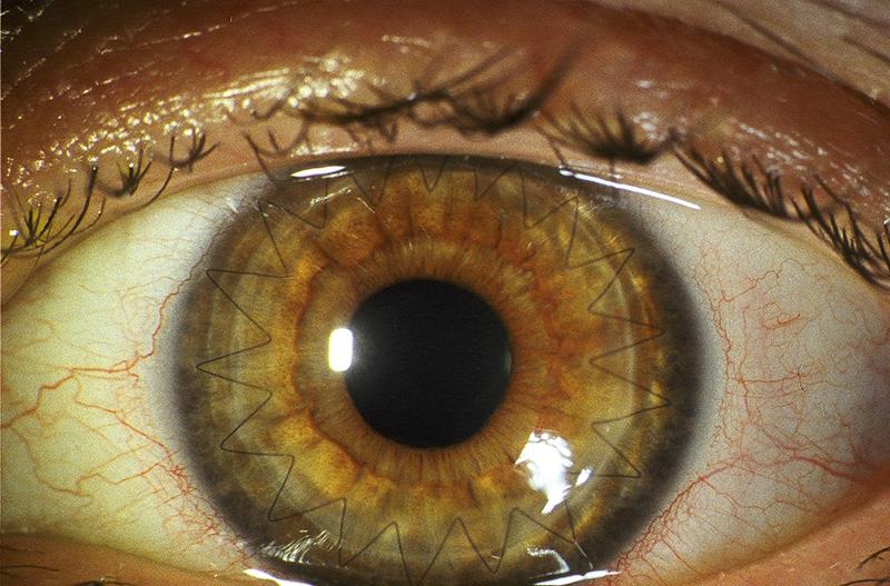 Trapianto di cornea preceduto da