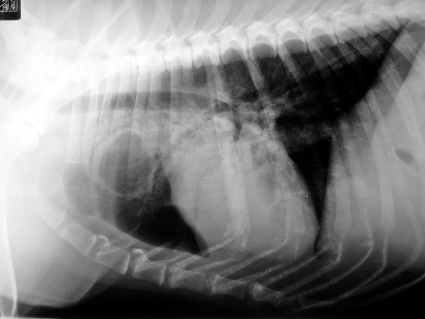 *** Bronchiectasia B. tubuliforme: bronchi dilatati al centro ma alla periferia si riducono bruscamente di diametro B.