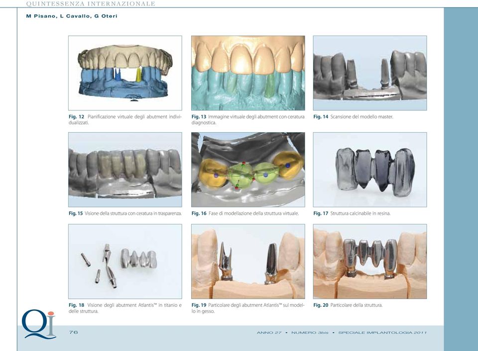 Fig. 18 Visione degli abutment Atlantis in titanio e delle struttura. Fig. 19 Particolare degli abutment Atlantis sul modello in gesso.