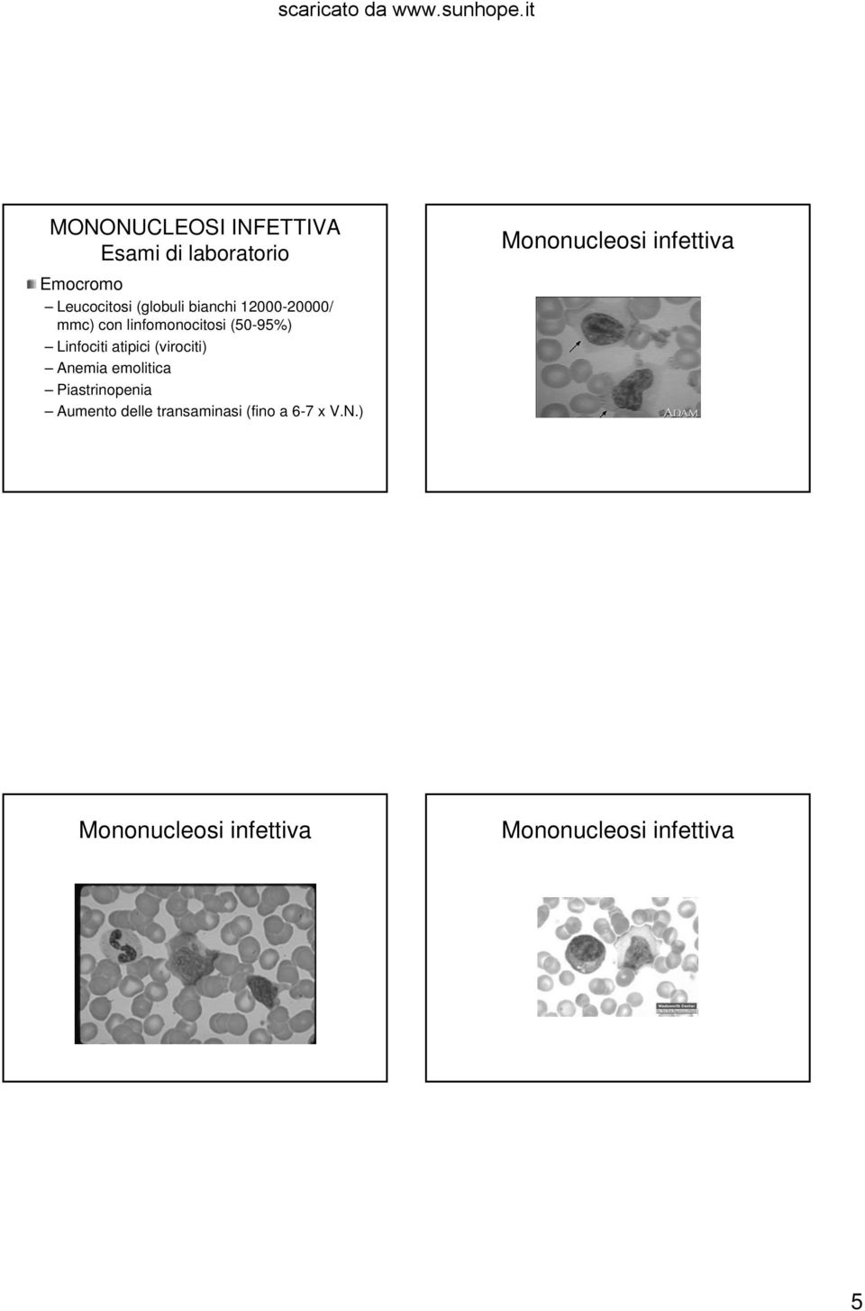 (50-95%) Linfociti atipici (virociti) Anemia