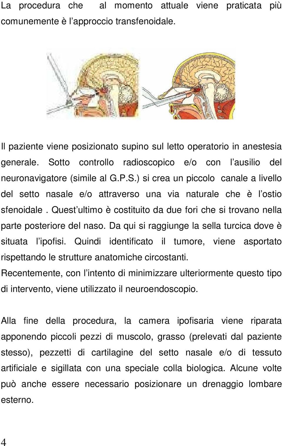 Quest ultimo è costituito da due fori che si trovano nella parte posteriore del naso. Da qui si raggiunge la sella turcica dove è situata l ipofisi.