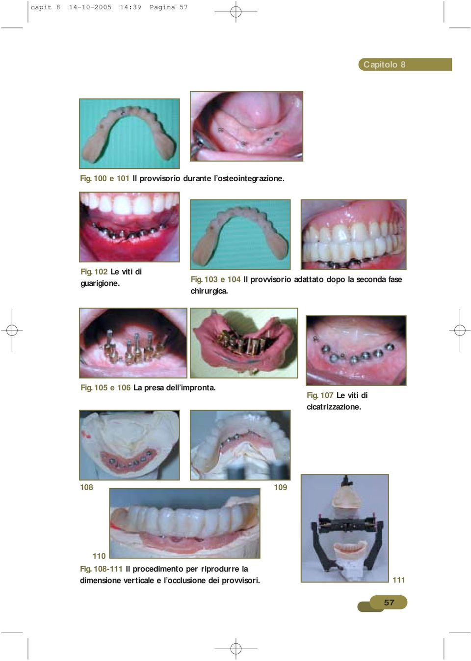 105 e 106 La presa dell impronta. Fig. 107 Le viti di cicatrizzazione. 108 109 110 Fig.