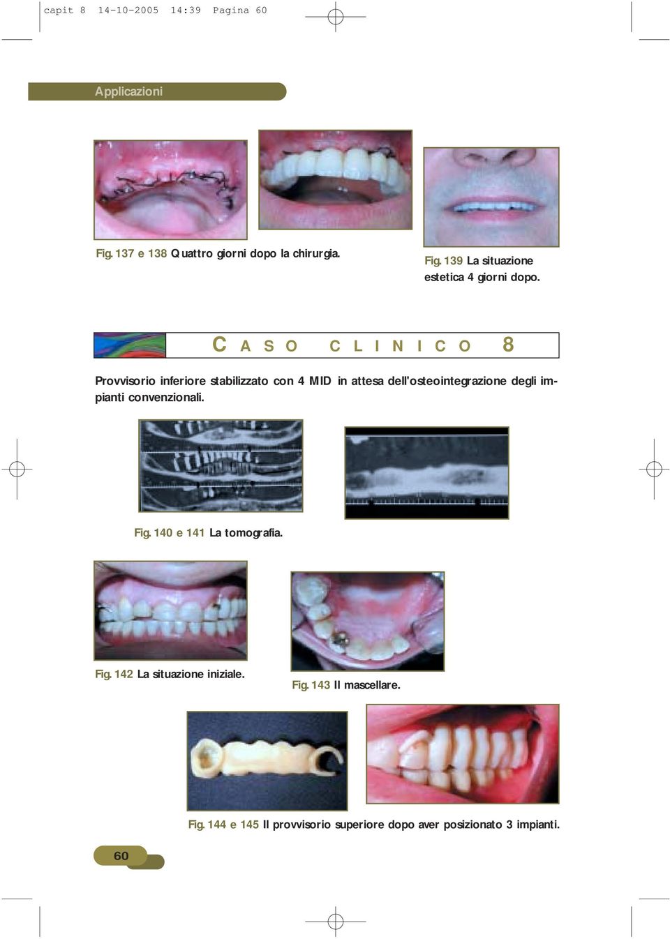 degli impianti convenzionali. Fig. 140 e 141 La tomografia. Fig. 142 La situazione iniziale. Fig. 143 Il mascellare.