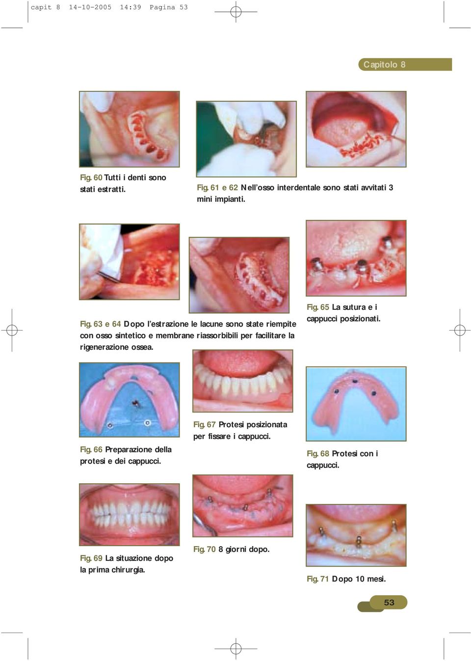 ossea. Fig. 65 La sutura e i cappucci posizionati. Fig. 66 Preparazione della protesi e dei cappucci. Fig. 67 Protesi posizionata per fissare i cappucci.