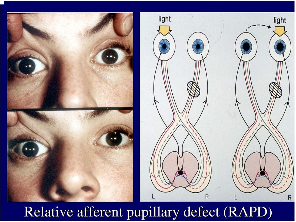 pupillary