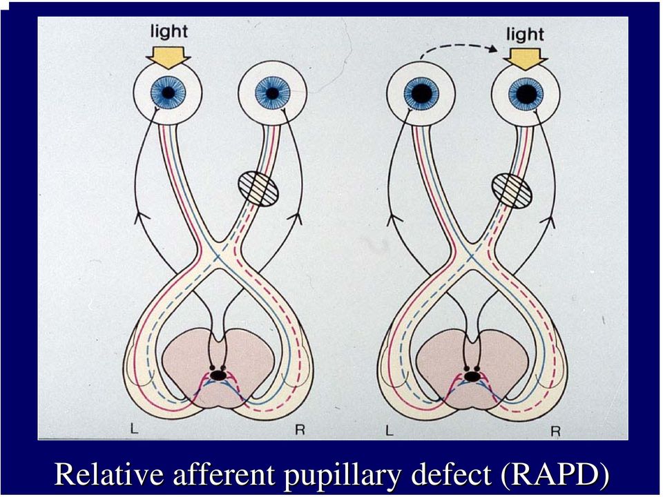 pupillary