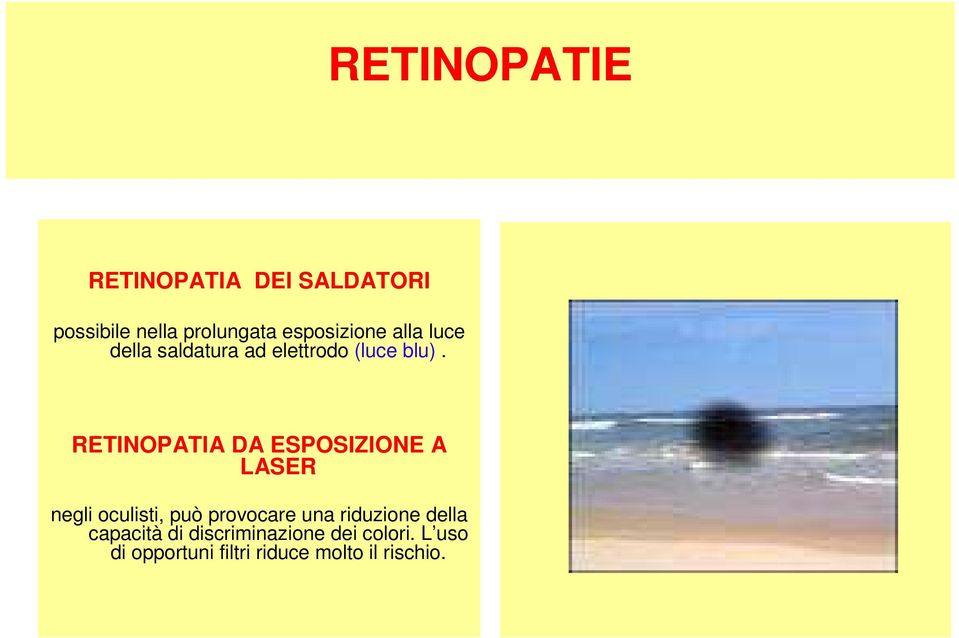 RETINOPATIA DA ESPOSIZIONE A LASER negli oculisti, può provocare una