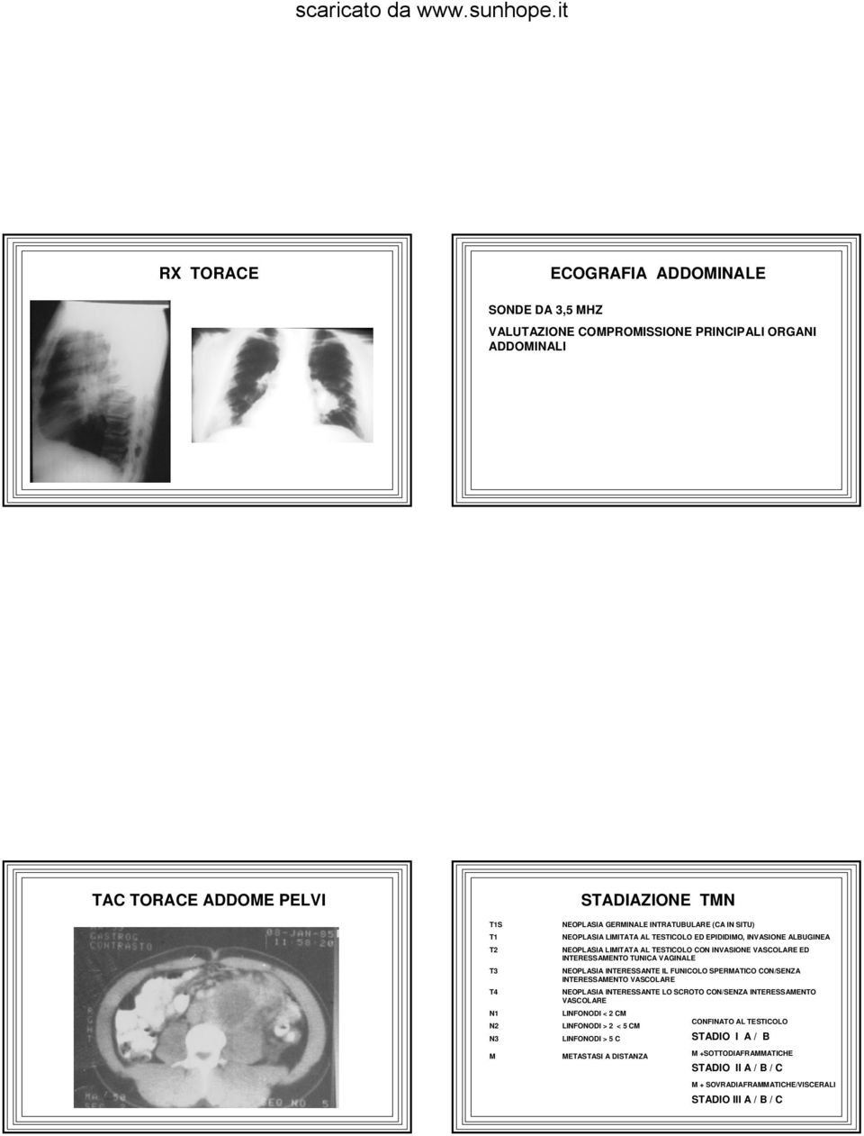 VAGINALE NEOPLASIA INTERESSANTE IL FUNICOLO SPERMATICO CON/SENZA INTERESSAMENTO VASCOLARE NEOPLASIA INTERESSANTE LO SCROTO CON/SENZA INTERESSAMENTO VASCOLARE LINFONODI < 2 CM