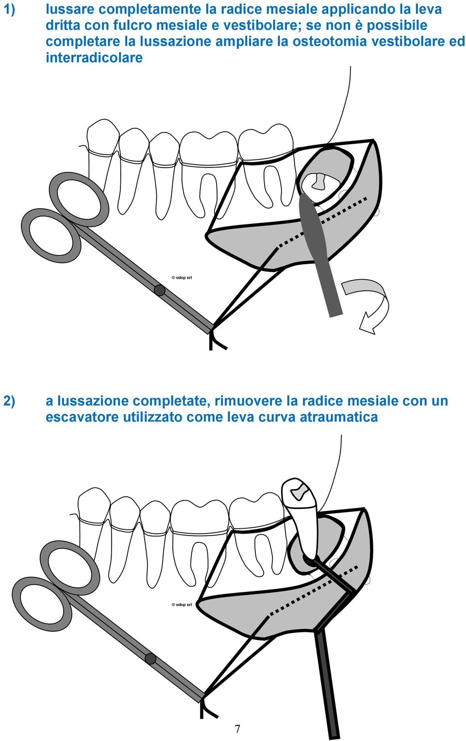 ampliare la osteotomia vestibolare ed interradicolare 2) a lussazione