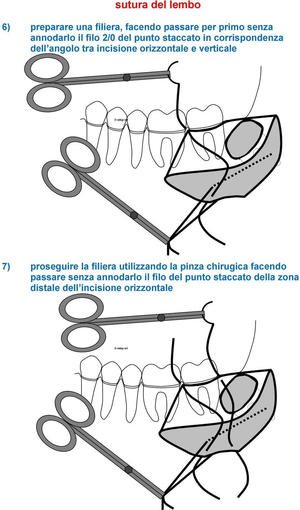 e verticale 7) proseguire la filiera utilizzando la pinza chirugica facendo passare