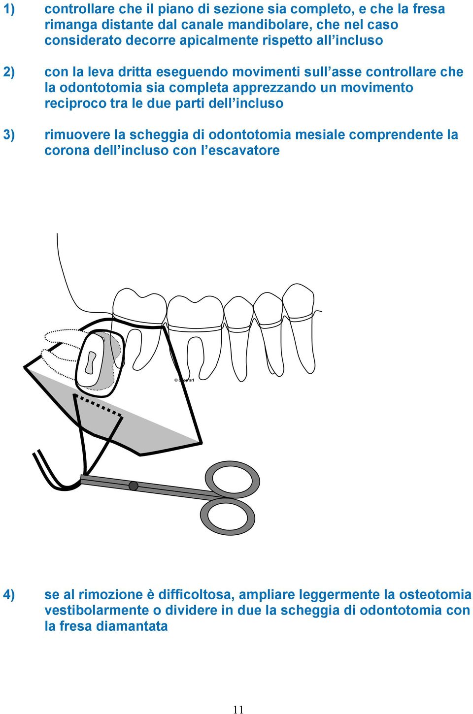 movimento reciproco tra le due parti dell incluso 3) rimuovere la scheggia di odontotomia mesiale comprendente la corona dell incluso con l