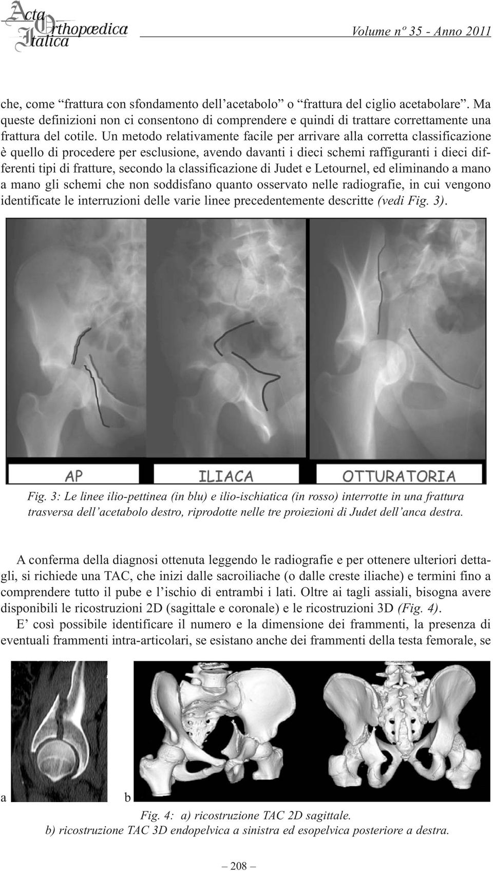 la classificazione di Judet e Letournel, ed eliminando a mano a mano gli schemi che non soddisfano quanto osservato nelle radiografie, in cui vengono identificate le interruzioni delle varie linee