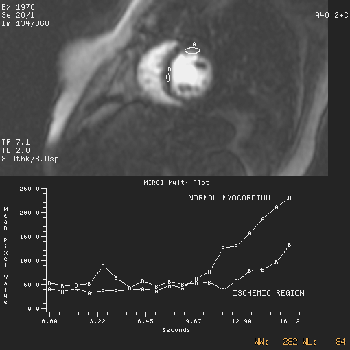 ISCHEMIA: Uptake gadolinio: Misurato con due