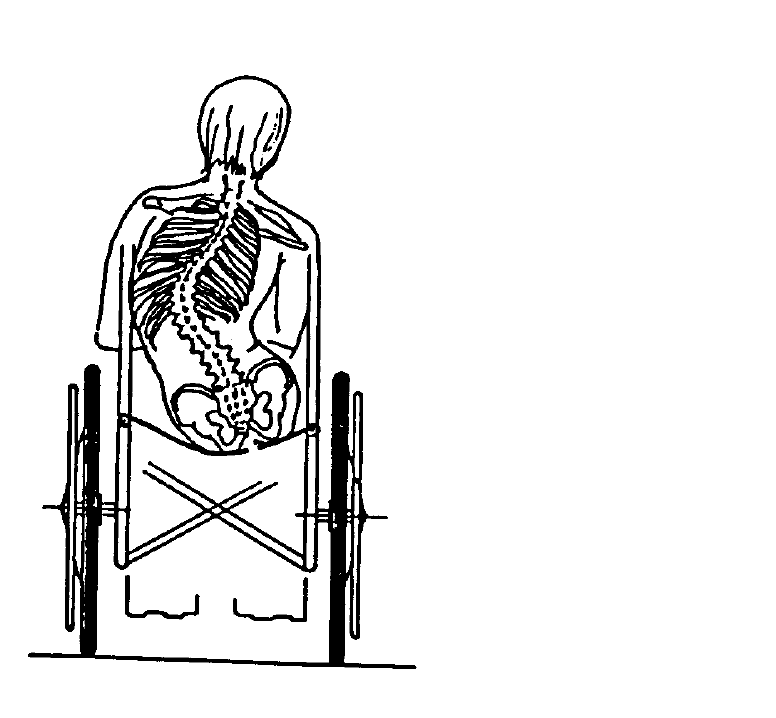 Fig. 8 Bacino obliquo (con deviazione compensatoria del rachide) provocato da un sedile troppo cedevole. ( da Spagnolin G.: La carrozzina. Ed. Ghedini. 1993).