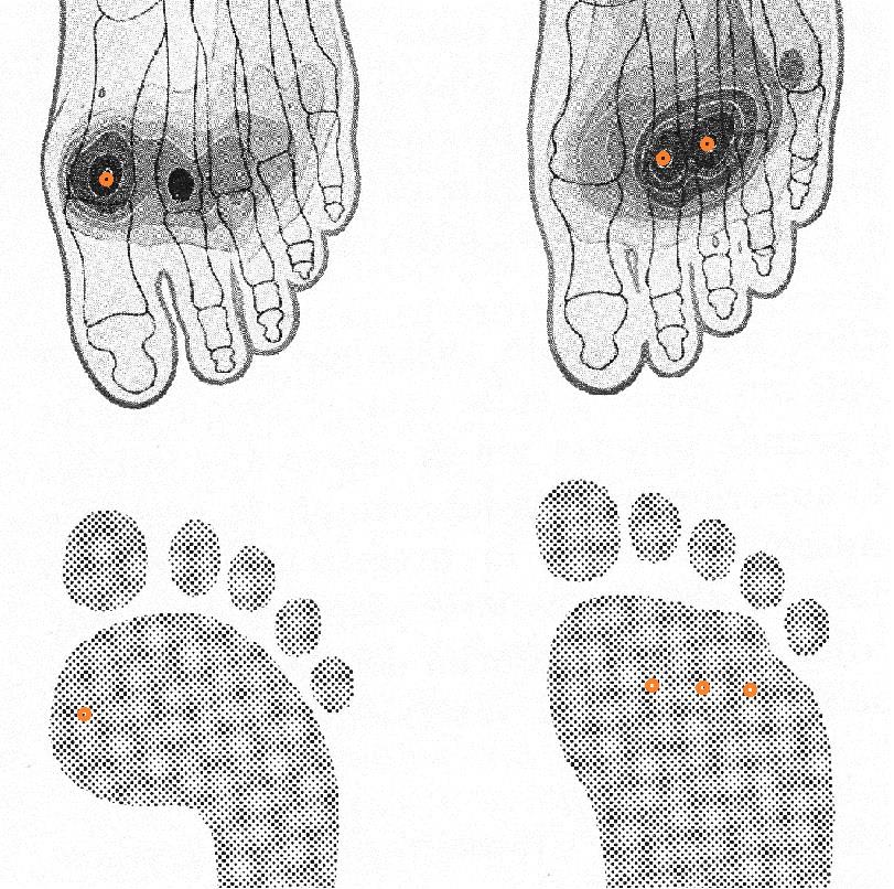 Trattamento: 1: calzature con plantare su misura scarico