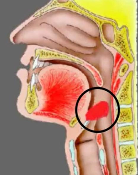 SOFFIO LARINGEO o CORNAGE Rumore stridente, prolungato, essenzialmente inspiratorio provocato dal passaggio dell aria attraverso una stenosi alta Lo stridore non grave può essere