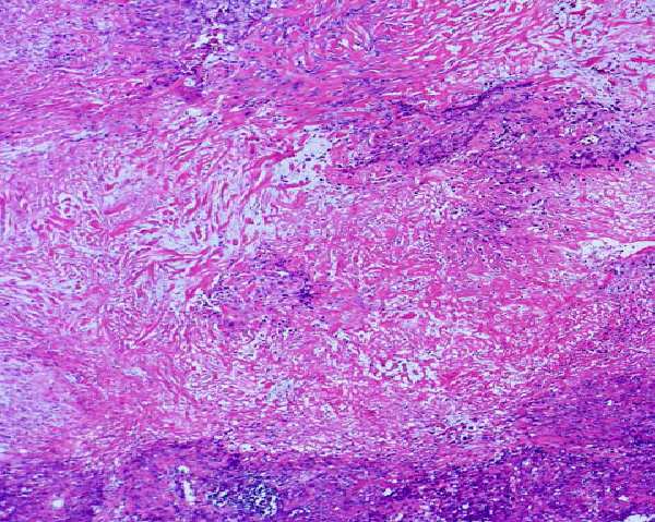 strati di cellule larghe con nucleoli prominenti (che lo fanno somigliare ad un carcinoma scarsamente differenziato ) e frequentemente