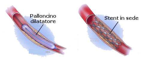 Aterotrombi degli arti inferiori: se iniziano a chiudersi per formazione dell ateroma danno il quadro clinico della claudicazio