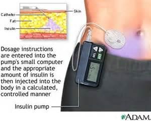 Metodi di somministrazione dell insulina Siringhe: aghi ipodermici standard collegati a cilindri vuoti. Disponibili in varie dimensioni, con aghi di varie lunghezze e spessore.