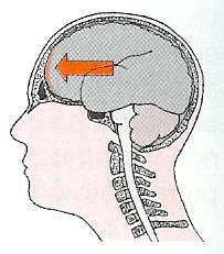 CONTUSIONE CEREBRALE Danno cerebrale grave dove si ha distruzione di tessuto nervoso (non si replica).