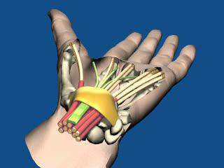 L IPERUSO DEI TENDINI NEL TUNNEL CARPALE NE PROVOCA IL RIGONFIAMENTO ( EDEMA) CON AUMENTO DELLA PRESSIONE ALL