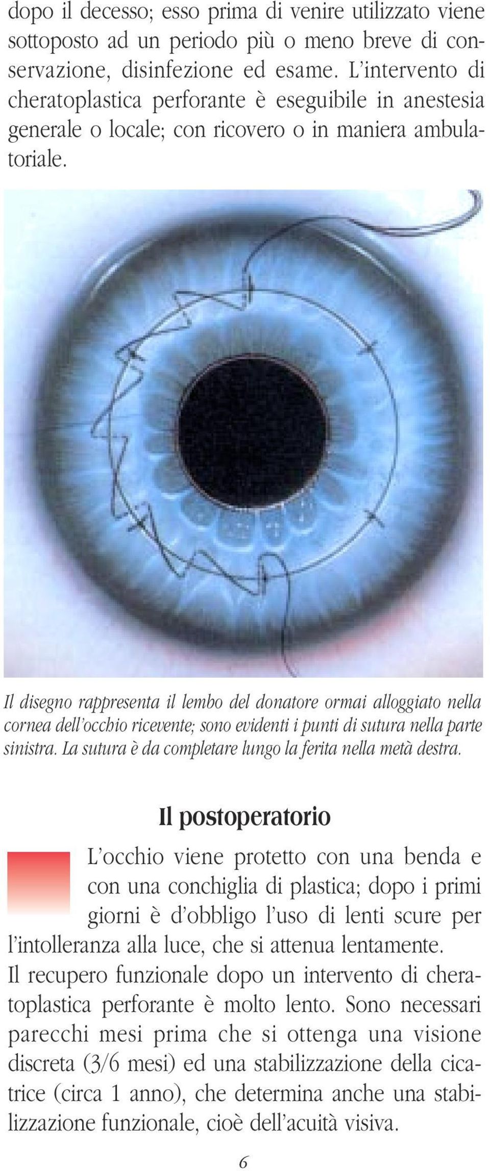 Il disegno rappresenta il lembo del donatore ormai alloggiato nella cornea dell occhio ricevente; sono evidenti i punti di sutura nella parte sinistra.
