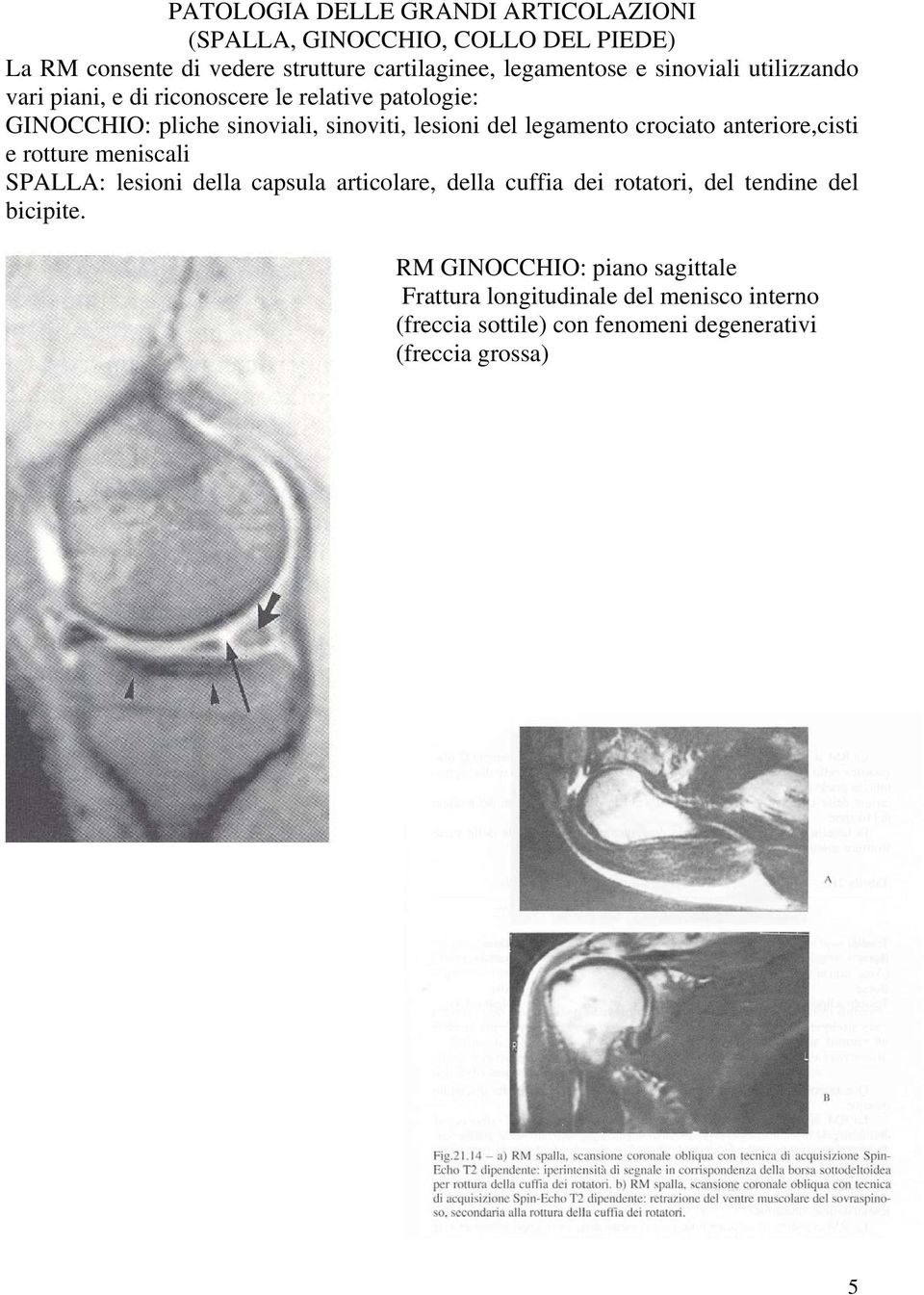 crociato anteriore,cisti e rotture meniscali SPALLA: lesioni della capsula articolare, della cuffia dei rotatori, del tendine del