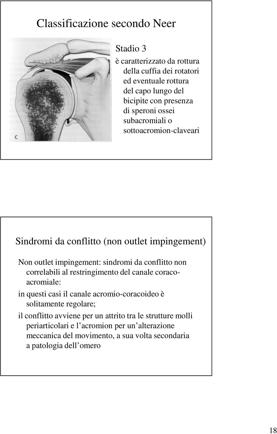 conflitto non correlabili al restringimento del canale coracoacromiale: in questi casi il canale acromio-coracoideo è solitamente regolare; il conflitto