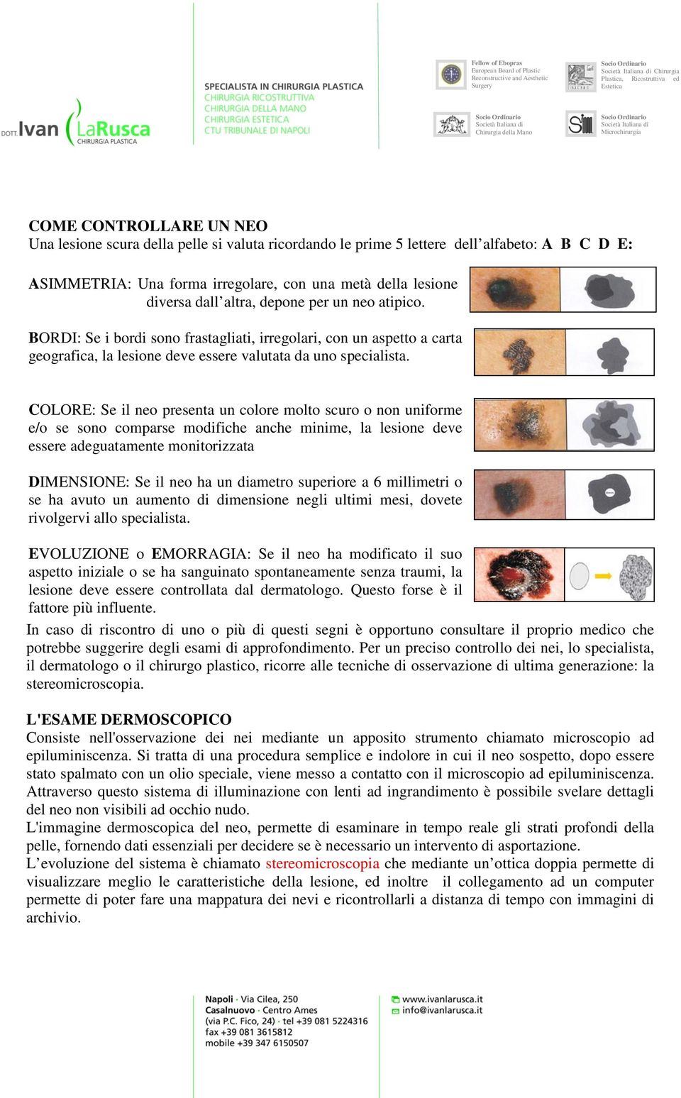 COLORE: Se il neo presenta un colore molto scuro o non uniforme e/o se sono comparse modifiche anche minime, la lesione deve essere adeguatamente monitorizzata DIMENSIONE: Se il neo ha un diametro