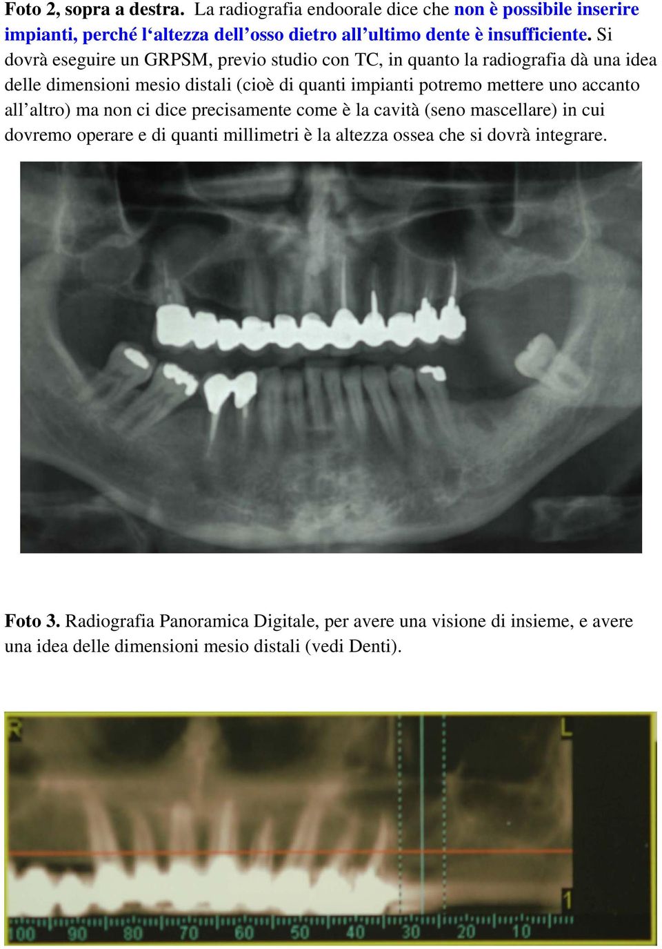 Si dovrà eseguire un GRPSM, previo studio con TC, in quanto la radiografia dà una idea delle dimensioni mesio distali (cioè di quanti impianti potremo