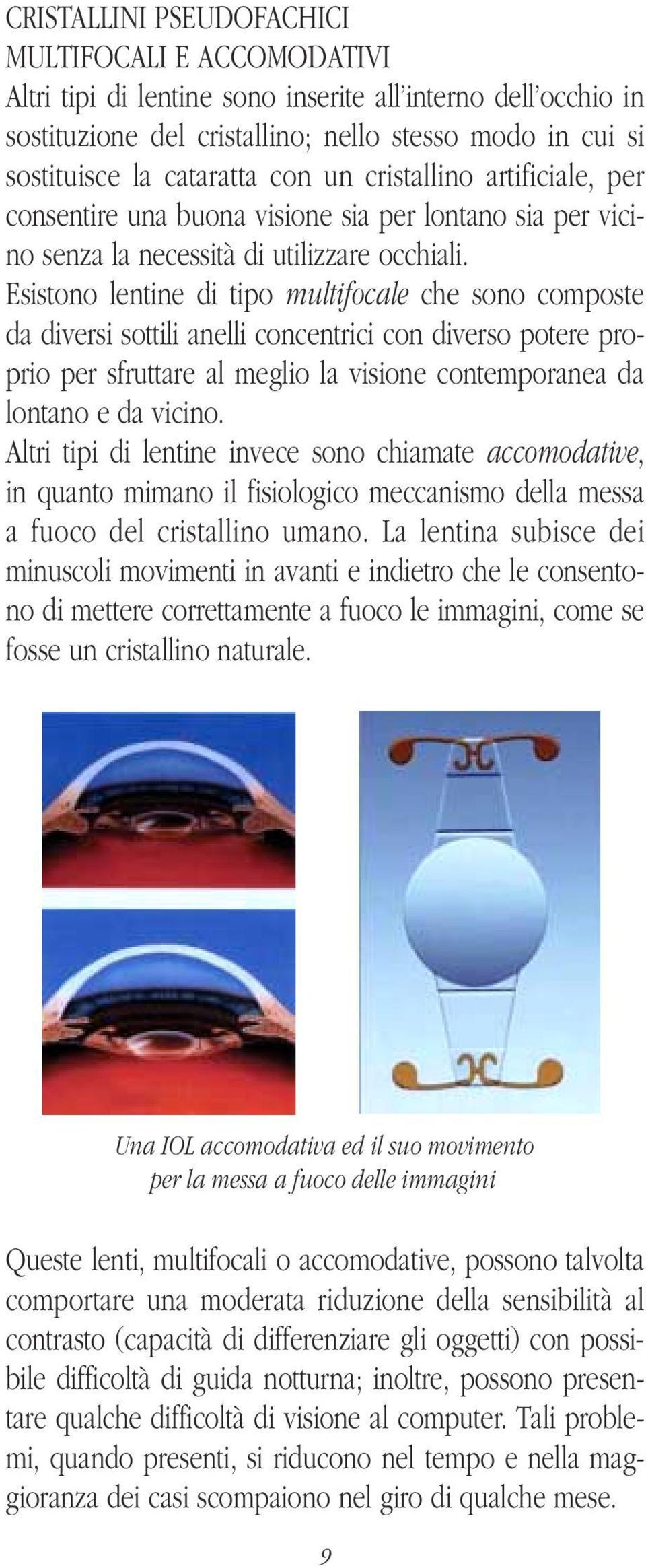 Esistono lentine di tipo multifocale che sono composte da diversi sottili anelli concentrici con diverso potere proprio per sfruttare al meglio la visione contemporanea da lontano e da vicino.