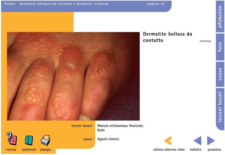 Dermatite bollosa da contatto continua