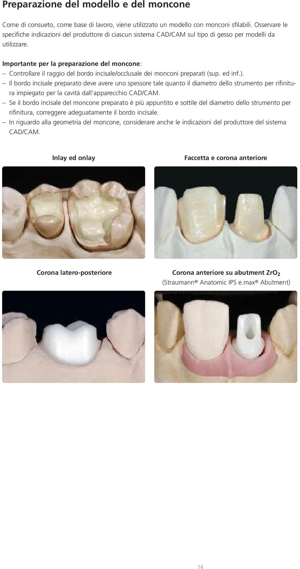 Importante per la preparazione del moncone: Controllare il raggio del bordo incisale/occlusale dei monconi preparati (sup. ed inf.).