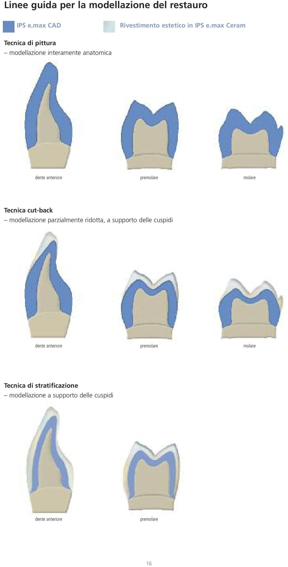 Tecnica cut-back modellazione parzialmente ridotta, a supporto delle cuspidi dente anteriore