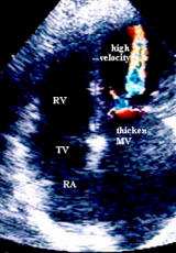 b) ECOGRAFIA BIDIMENSIONALE: mediante l'emissione di raggi ultrasonori in varie direzioni questa metodica fornisce un'immagine del cuore a due dimensioni e in tempo reale.
