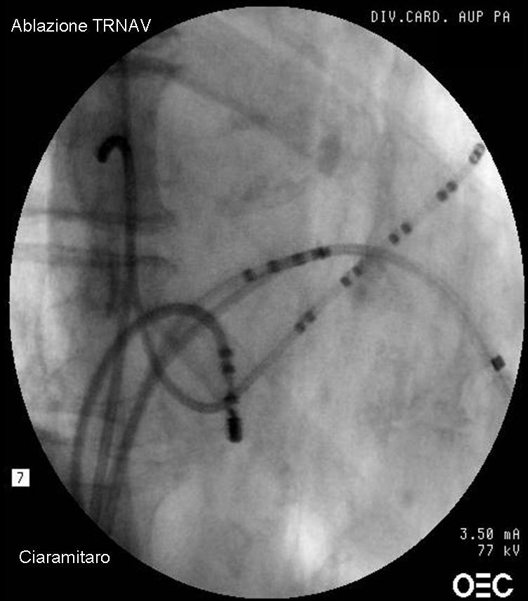 L ablazione transcaterere