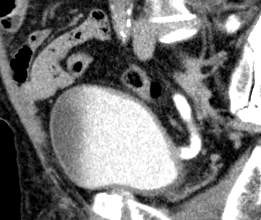 Radiologia Civico Pa A B C D E F Neoplasia estesa della parete postero-laterale dx della vescica senza urostasi.