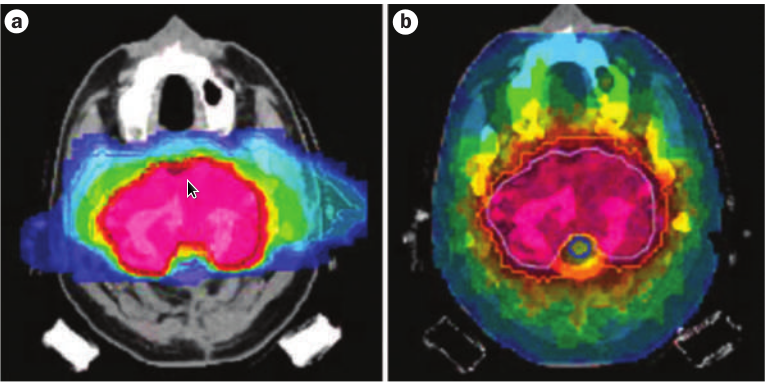 1.2 Parametri fisici in radioterapia 10 efficace nei confronti dei tumori della testa e del collo, della base del cranio, dei polmoni, del fegato, della prostata, delle ossa e dei tessuti molli,